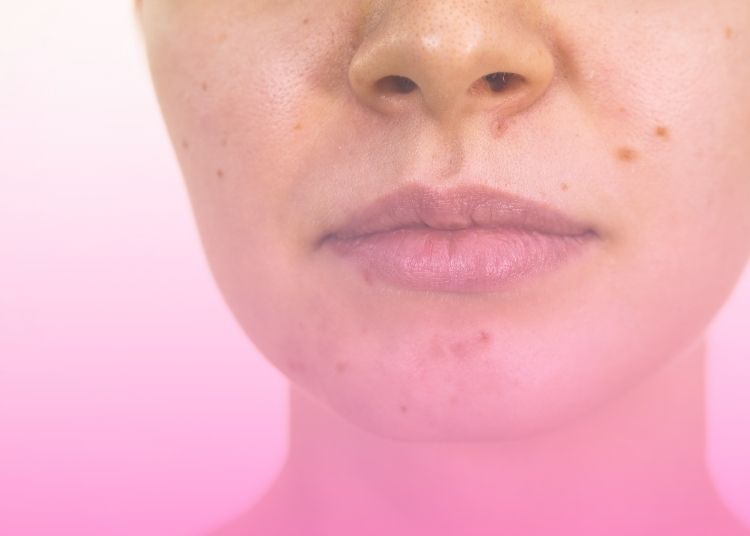 tratamientos caseros para eliminar el acne