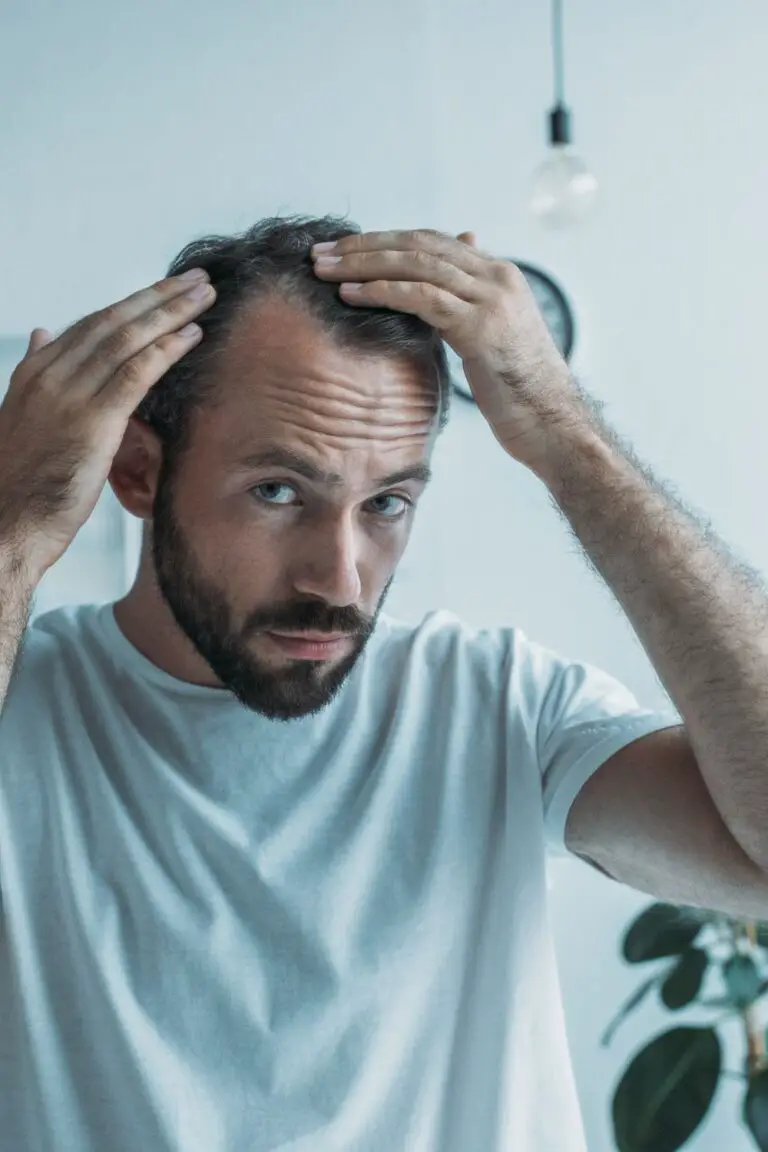 Por qué a los hombres se les cae el cabello